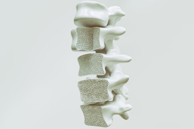 Osteoporosis, la enfermedad silenciosa