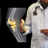 Qué es una prótesis articular y cómo es su rehabilitación