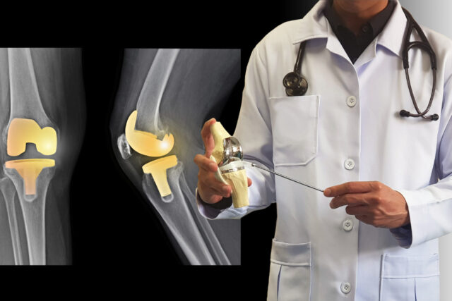 ¿Qué es una prótesis articular y cómo se rehabilita?